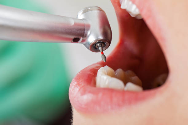 Best Urgent Tooth Repair  in Social Circle, GA